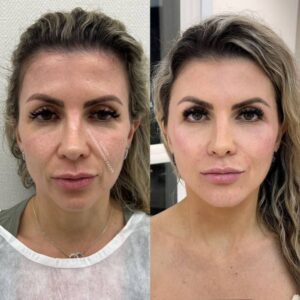 antes-e-depois-corporal-Dr.-Mateus-16-ml-22529795