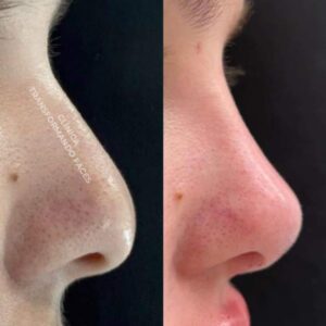 antes-e-depois-rinomodelacao-Dra.-Valeria-2-ml-01d419bc