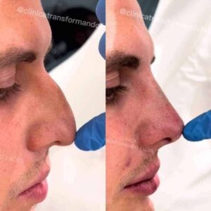 antes-e-depois-rinomodelacao-nariz6-2cf482d6